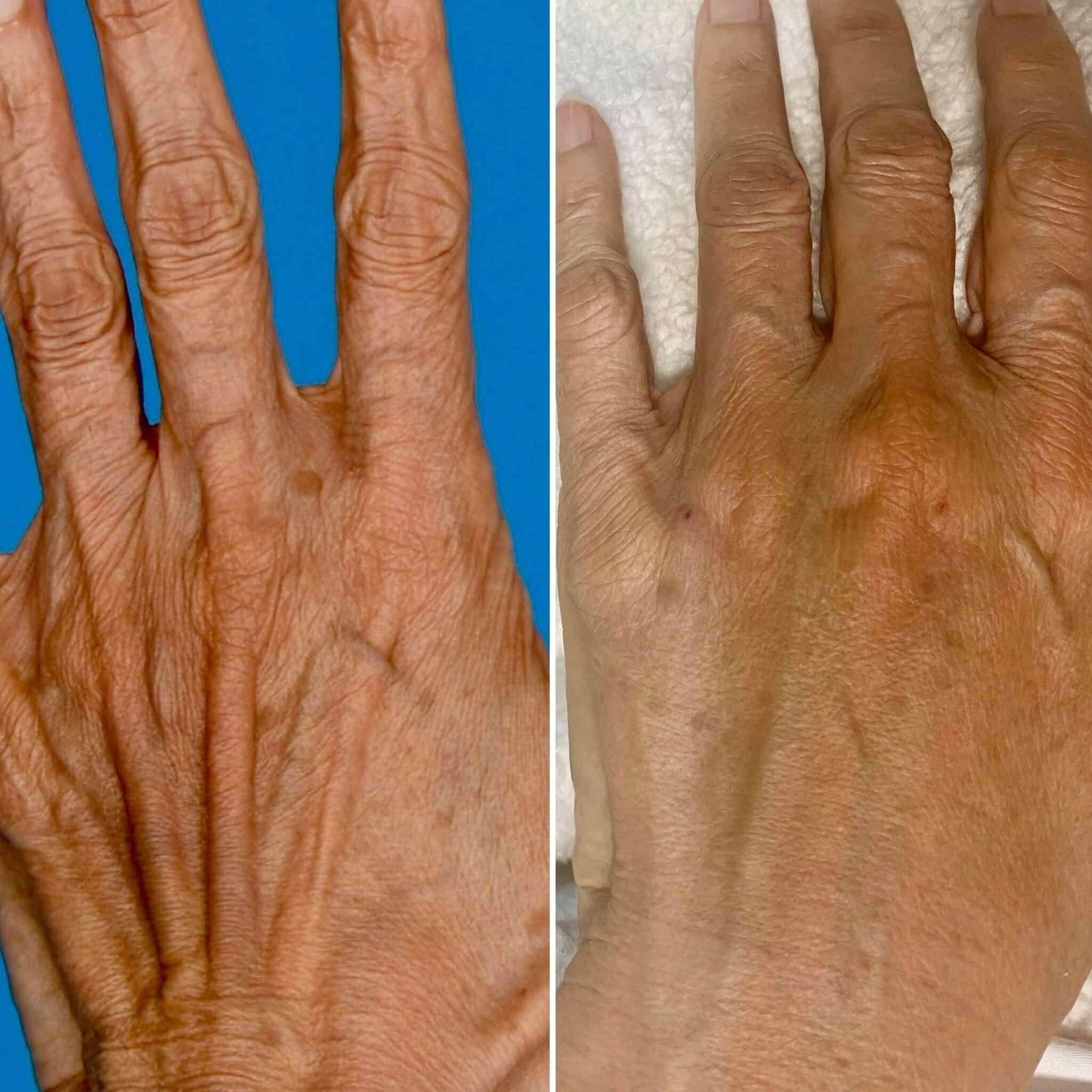 Hand Rejuvenation by Mesotherapy